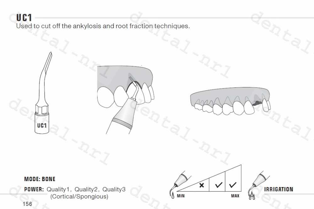 Exclcymosis Spitze UC1/ UC2/ UC3 fit woodpecker /mectron ultrasurgery,CE/FDA