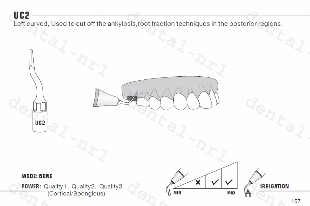 Exclcymosis Spitze UC1/ UC2/ UC3 fit woodpecker /mectron ultrasurgery,CE/FDA
