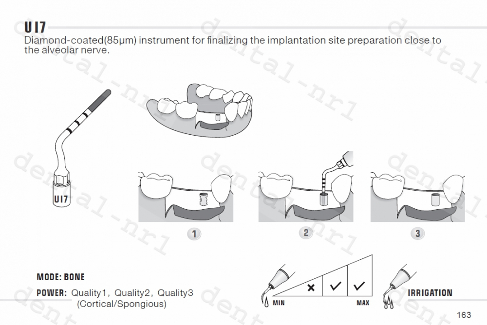 Implantation Spitze UI1, 5, 6, 7 für *mectron /woodpecker ultrasurgery,CE/FDA