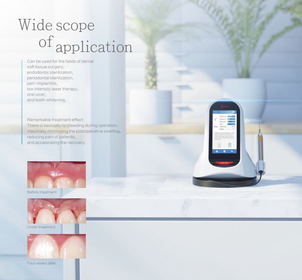 (Sommerangebote)Woodpecker LX16 PLUS, Innovatives blaues Halbleiterlasertherapiegerät mit drei Wellenlängen,CE/FDA