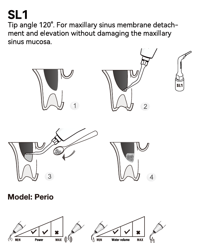 Woodpecker Sinuslifting Spitze SL1, 2, 3, 4, 5, für Surgic Smart von woodpecker/*Acteon kompatibel,CE/FDA