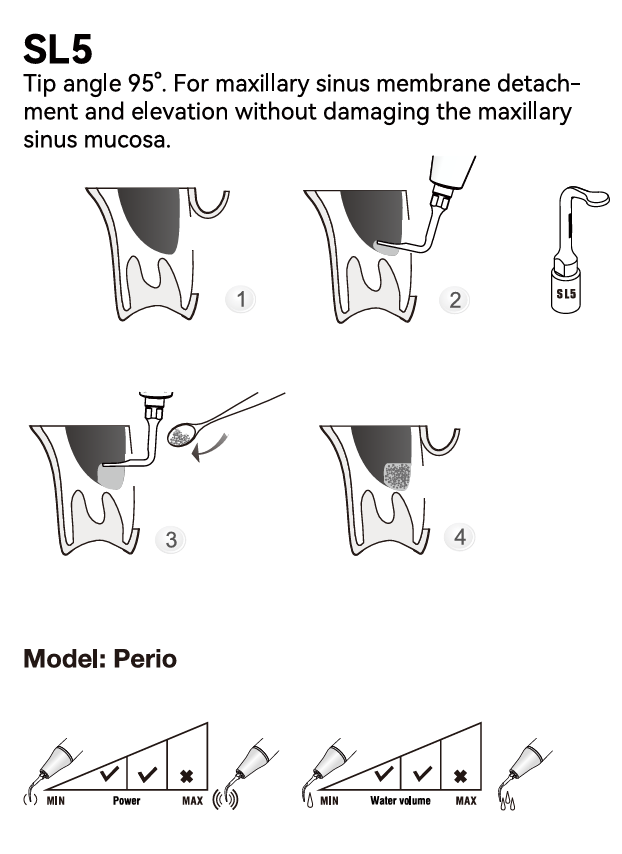Woodpecker Sinuslifting Spitze SL1, 2, 3, 4, 5, für Surgic Smart von woodpecker/*Acteon kompatibel,CE/FDA