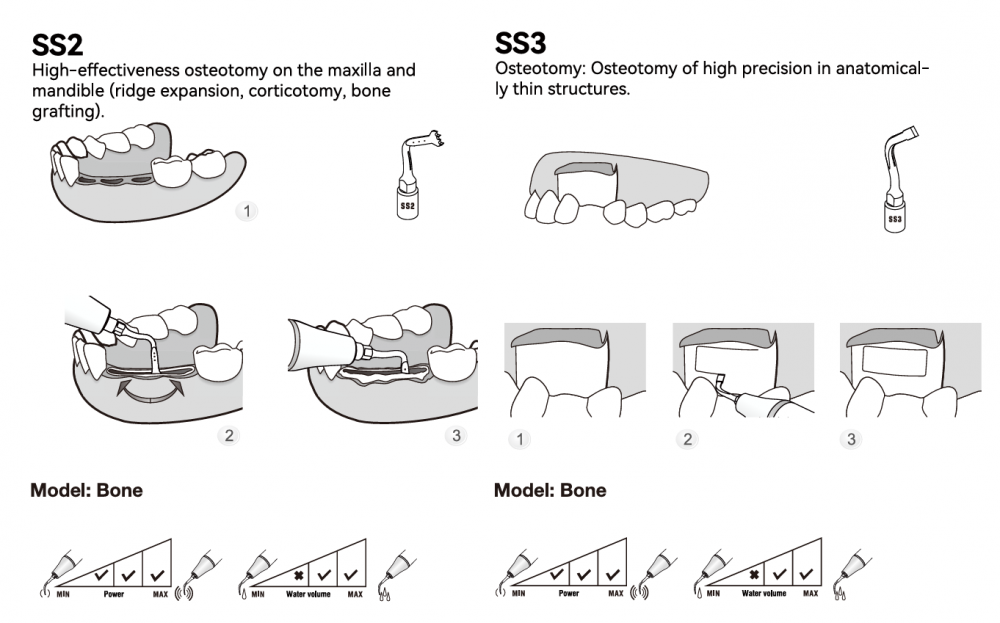 Woodpecker Piezo Spitze für Osteotomie SS1/ SS1L/SS1R/SS2/SS3/SS4/SS5/SS8/SS9, für Surgic Smart von woodpecker/* Acteon kompatibel, CE/FDA