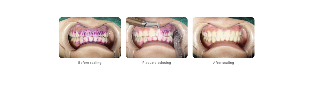 (Angebote!)Woodpecker Dental Scaler und Air Polisher AP-B,Elegantes Grau, schnelleres und bequemeres Scaling.CE/FDA