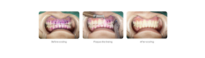 (Angebote!)Woodpecker Dental Scaler und Air Polisher AP-B,Elegantes Grau, schnelleres und bequemeres Scaling.CE/FDA